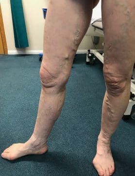 what is a varicose vein