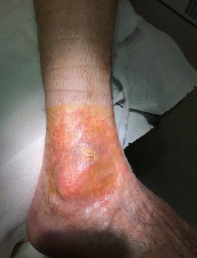 Chronic Leg Ulcer